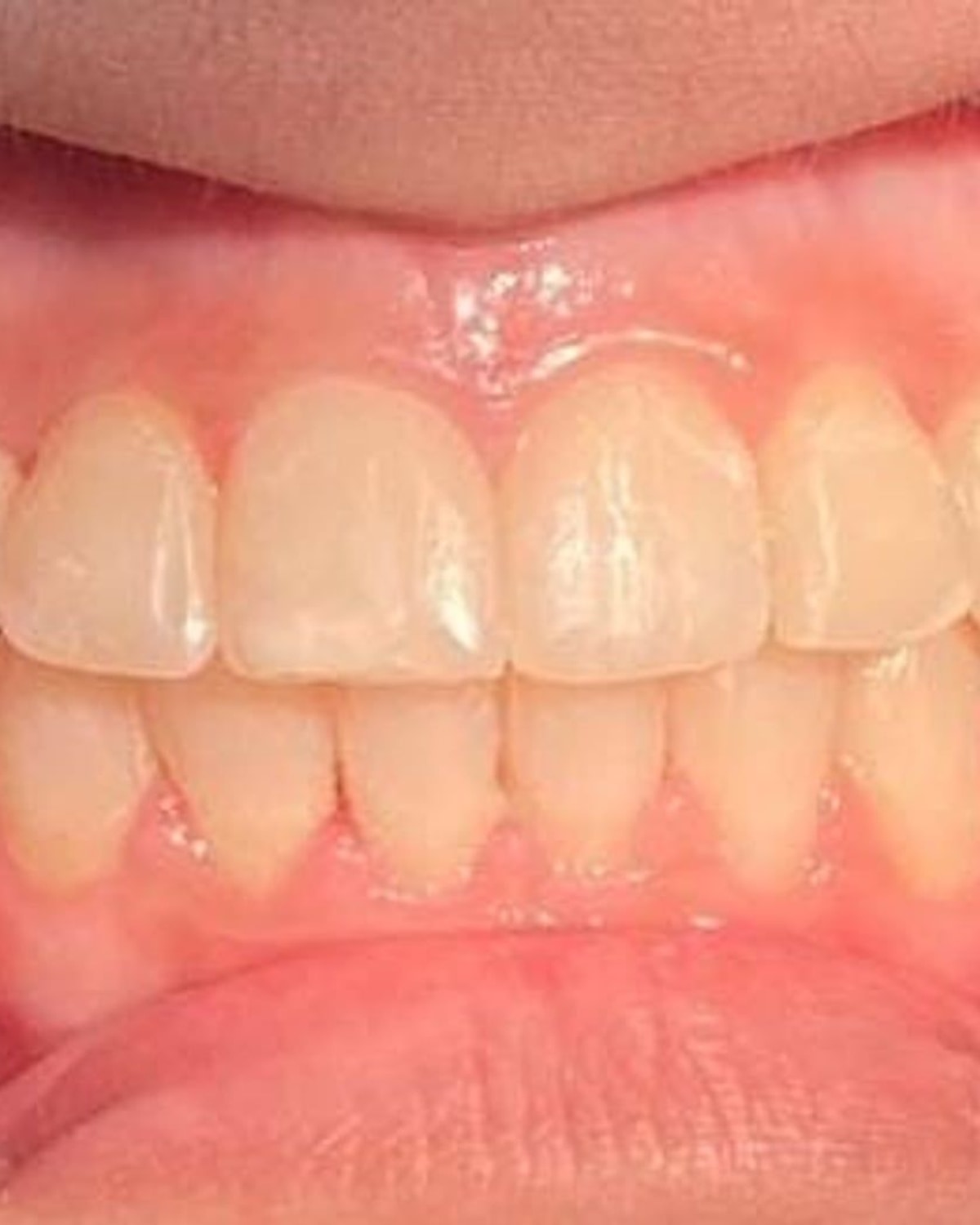 Straight, aligned teeth after orthodontic treatment at Reliance Hospital