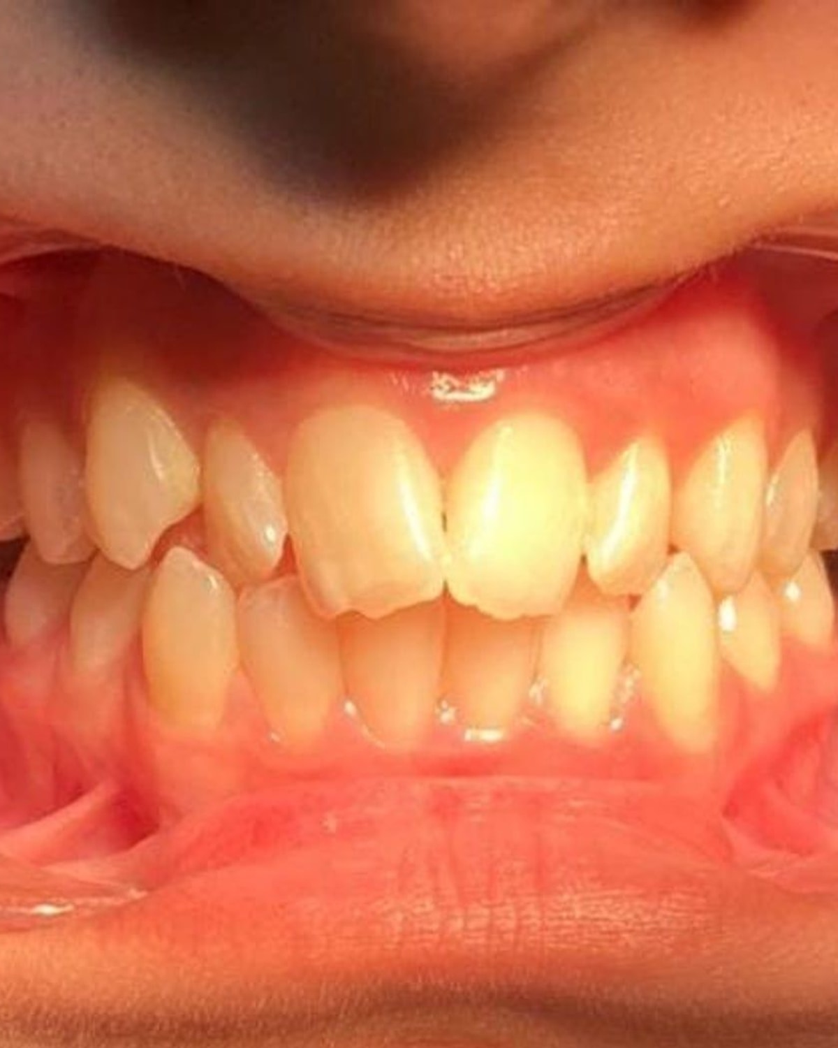 Crowded, misaligned teeth before orthodontic treatment