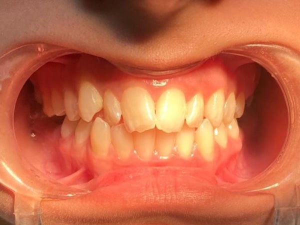Crowded teeth before orthodontic treatment
