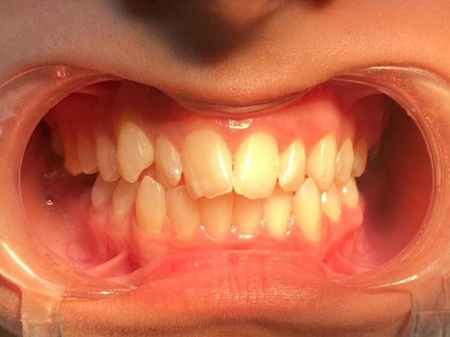 Crowded teeth before orthodontic treatment