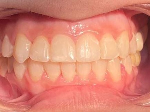 Straight, aligned teeth after orthodontic treatment