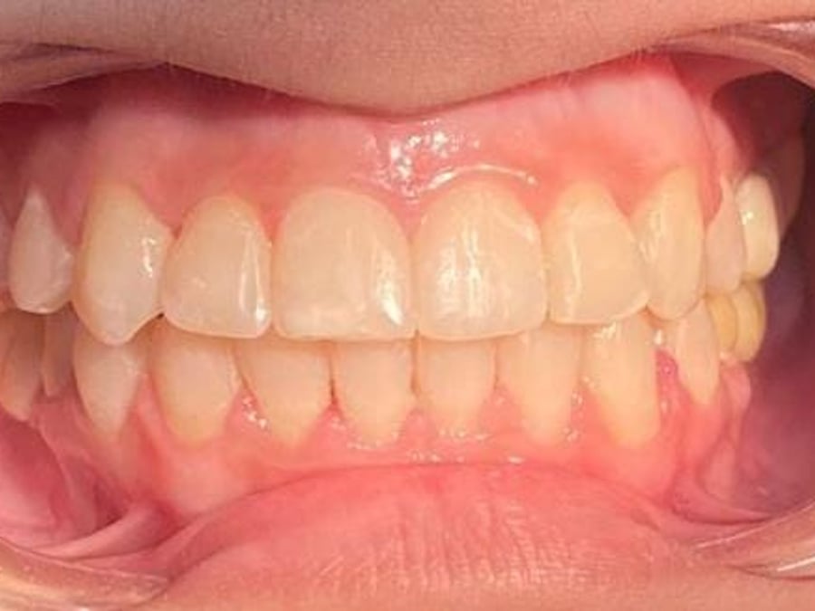 Straight, aligned teeth after orthodontic treatment