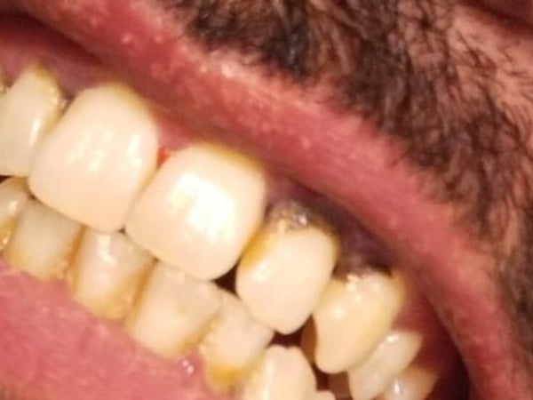 Stained and discoloured teeth before whitening