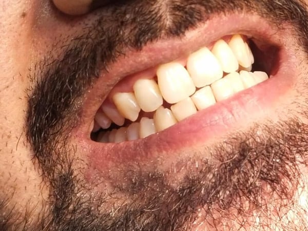 Bright, clean teeth after whitening treatment