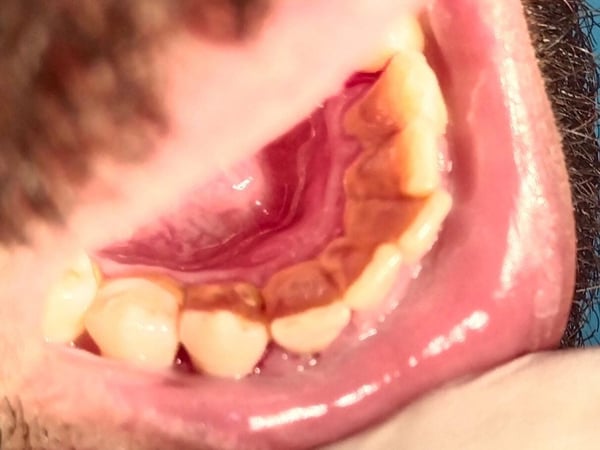 Heavy tartar buildup before professional cleaning