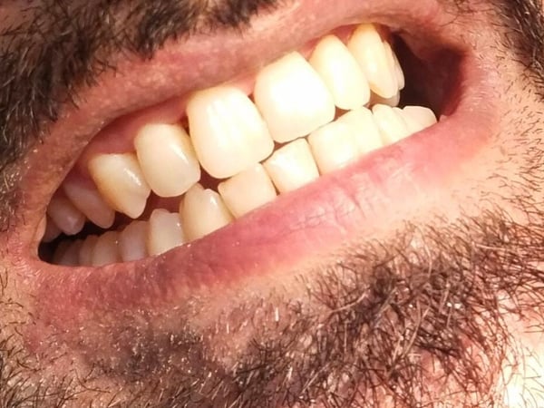 Healthy, clean teeth after scaling and polishing