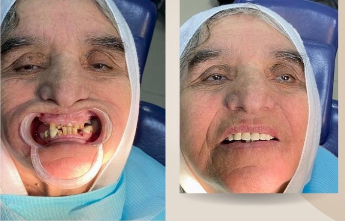 Complete denture rehabilitation result