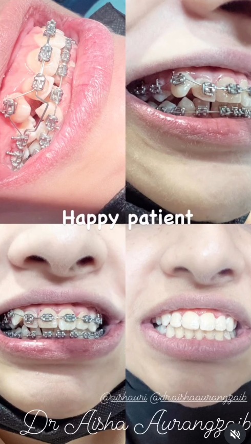 Teeth alignment progress with metal braces